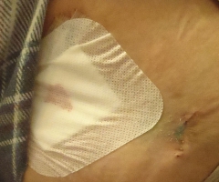 Pam's Incision
